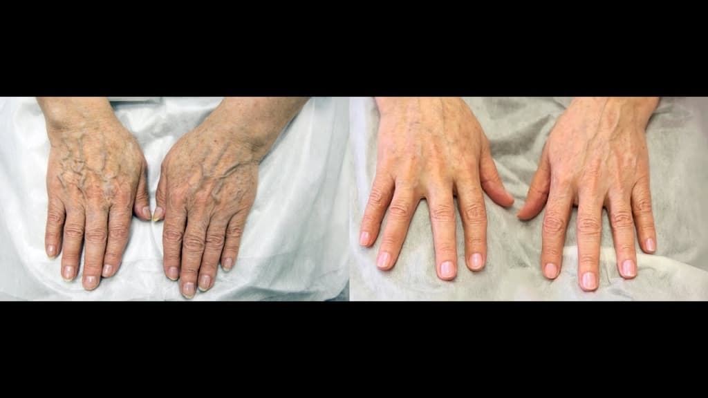 maxresdefault 1024x576 - Способы омоложения кожи рук