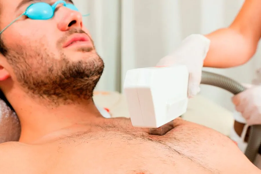 Лазерная эпиляция для мужчин