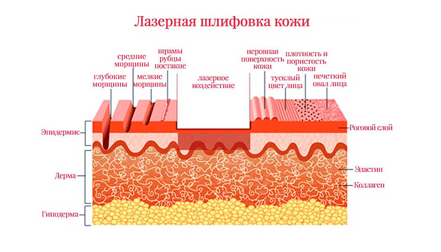Воздействие лазера на кожу